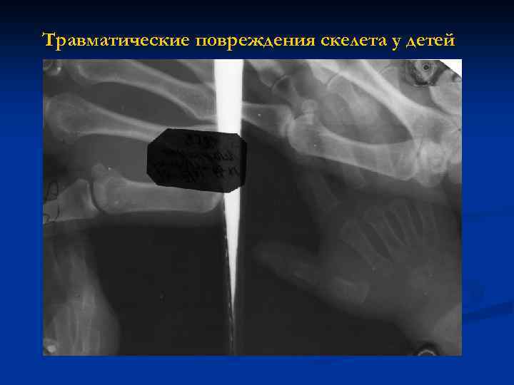 Травматические повреждения скелета у детей 