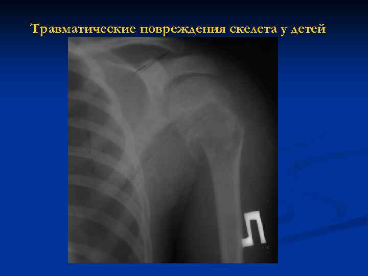 Травматические повреждения скелета у детей 