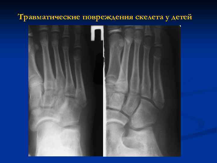 Травматические повреждения скелета у детей 