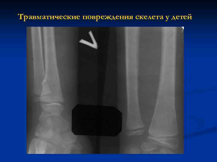 Травматические повреждения скелета у детей 