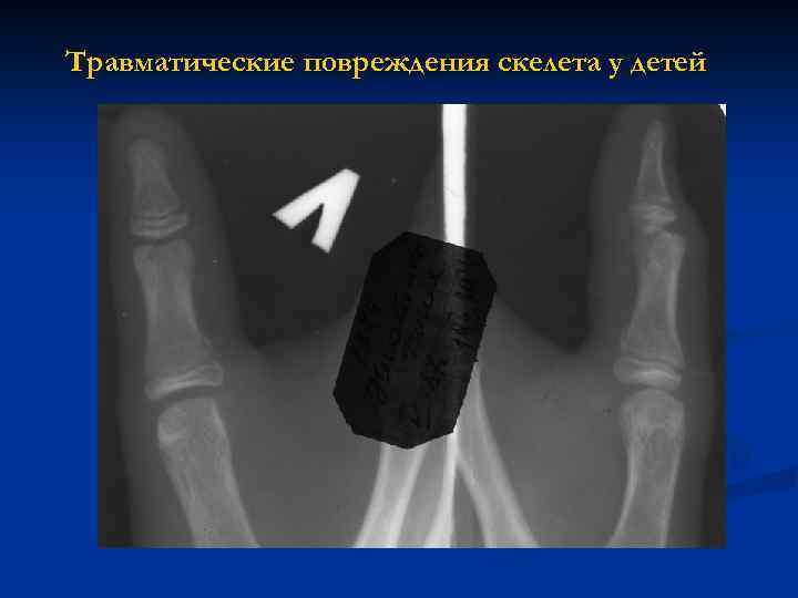 Травматические повреждения скелета у детей 