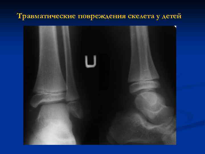 Травматические повреждения скелета у детей 