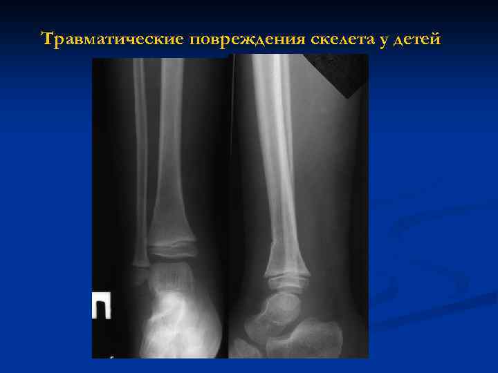 Травматические повреждения скелета у детей 