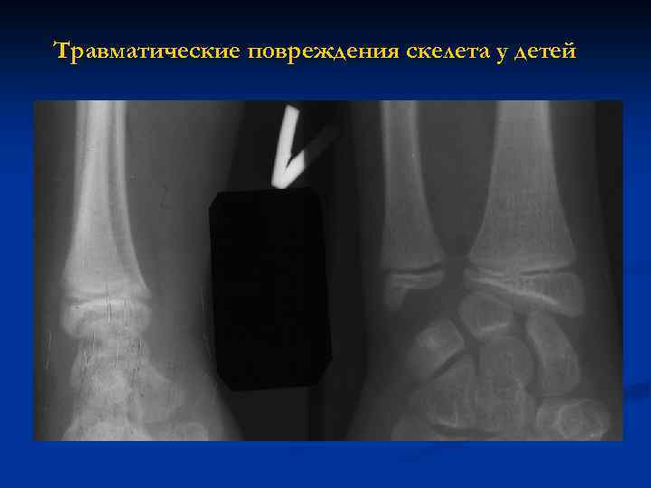 Травматические повреждения скелета у детей 