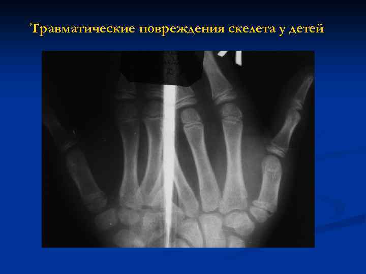 Травматические повреждения скелета у детей 