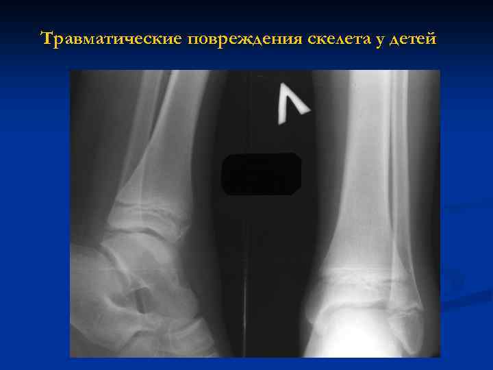 Травматические повреждения скелета у детей 