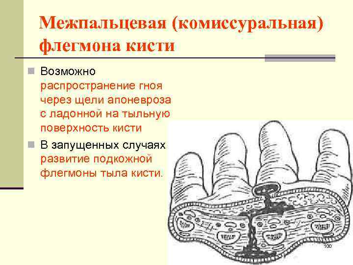 Межпальцевая (комиссуральная) флегмона кисти n Возможно распространение гноя через щели апоневроза с ладонной на