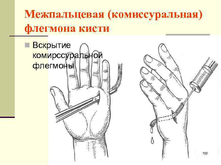 Межпальцевая (комиссуральная) флегмона кисти n Вскрытие комирссуральной флегмоны 102 
