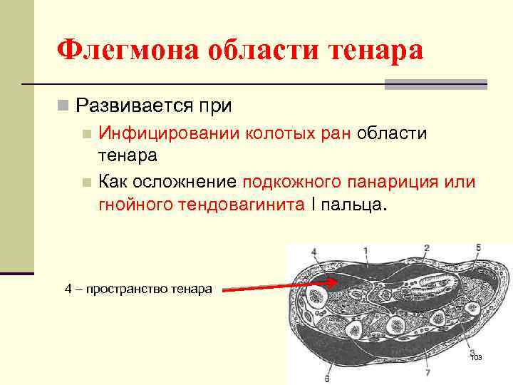 Флегмона области тенара n Развивается при n Инфицировании колотых ран области тенара n Как