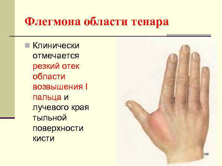 Флегмона области тенара n Клинически отмечается резкий отек области возвышения I пальца и лучевого