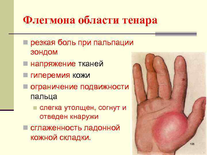 Флегмона области тенара n резкая боль при пальпации зондом n напряжение тканей n гиперемия