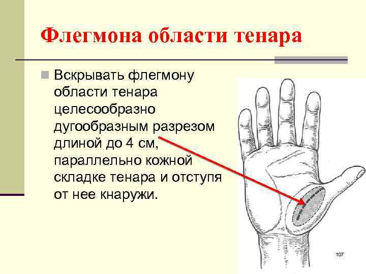 Флегмона области тенара n Вскрывать флегмону области тенара целесообразно дугообразным разрезом длиной до 4