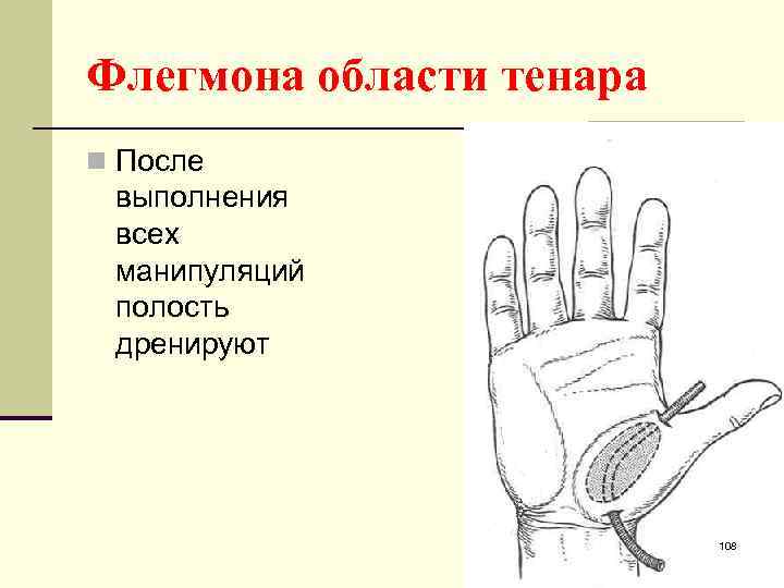Флегмона области тенара n После выполнения всех манипуляций полость дренируют 108 