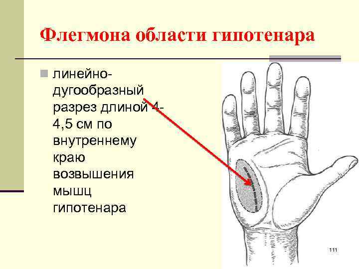 Флегмона области гипотенара n линейно- дугообразный разрез длиной 44, 5 см по внутреннему краю