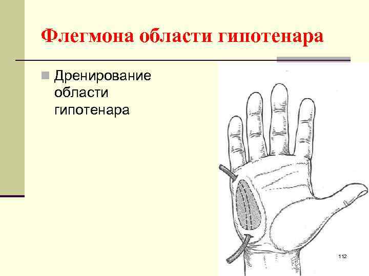Флегмона области гипотенара n Дренирование области гипотенара 112 