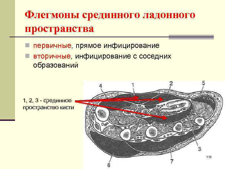 Флегмоны срединного ладонного пространства n первичные, прямое инфицирование n вторичныe, инфицирование с соседних образований