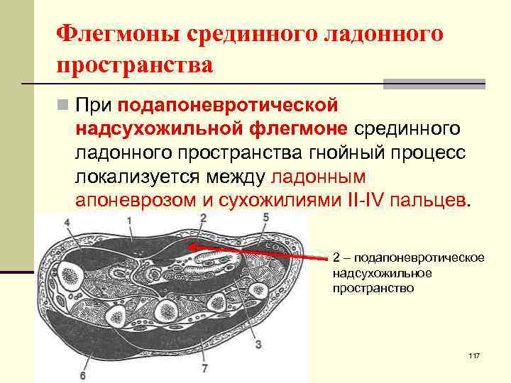 Флегмоны срединного ладонного пространства n При подапоневротической надсухожильной флегмоне срединного ладонного пространства гнойный процесс
