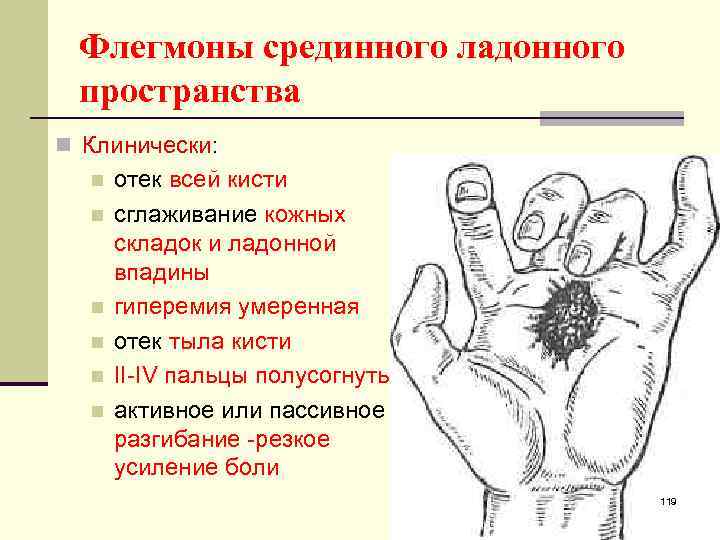 Флегмоны срединного ладонного пространства n Клинически: n n n отек всей кисти сглаживание кожных