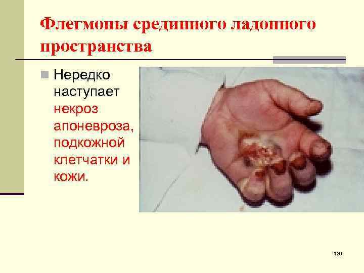 Флегмоны срединного ладонного пространства n Нередко наступает некроз апоневроза, подкожной клетчатки и кожи. 120