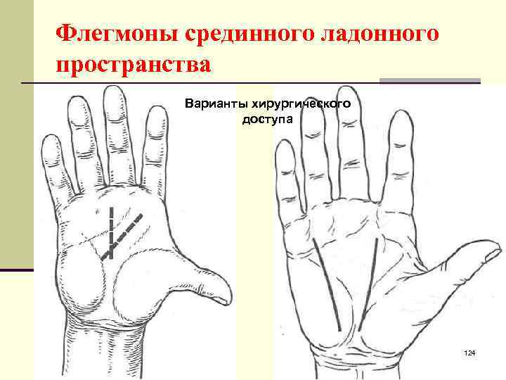 Вскрытие подапоневротической флегмоны