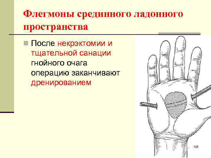 Флегмоны срединного ладонного пространства n После некрэктомии и тщательной санации гнойного очага операцию заканчивают