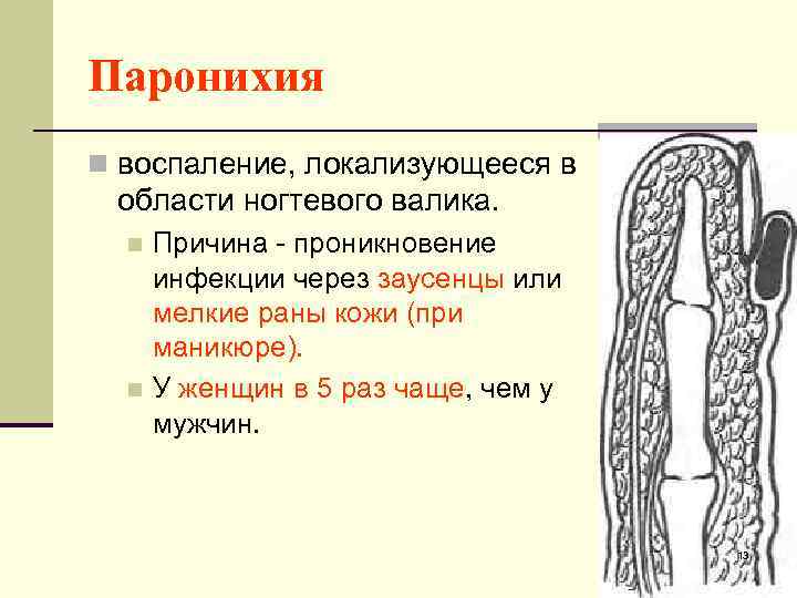 Паронихия n воспаление, локализующееся в области ногтевого валика. Причина - проникновение инфекции через заусенцы
