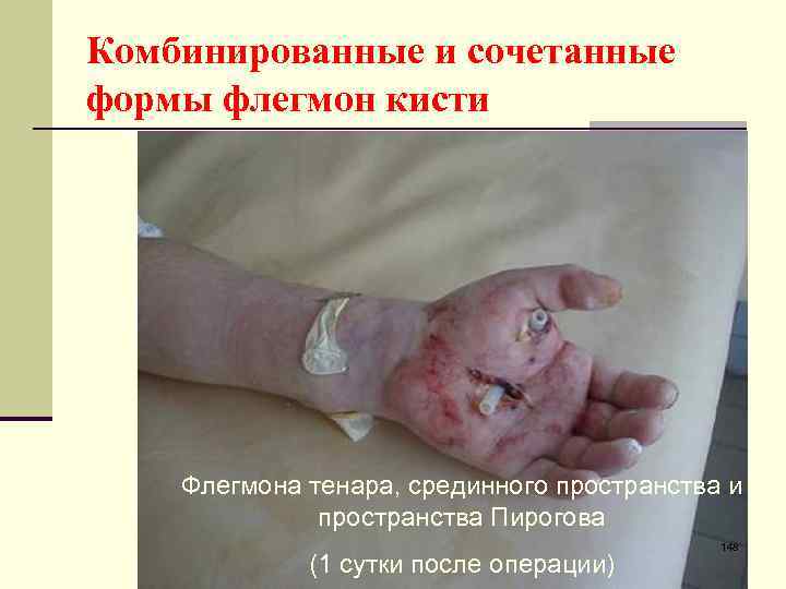 Комбинированные и сочетанные формы флегмон кисти Флегмона тенара, срединного пространства и пространства Пирогова (1