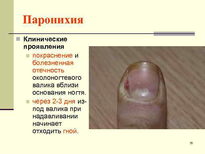 Паронихия n Клинические проявления n покраснение и болезненная отечность околоногтевого валика вблизи основания ногтя.
