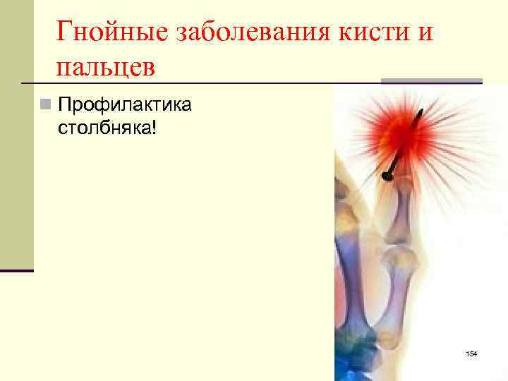 Гнойные заболевания кисти и пальцев n Профилактика столбняка! 154 