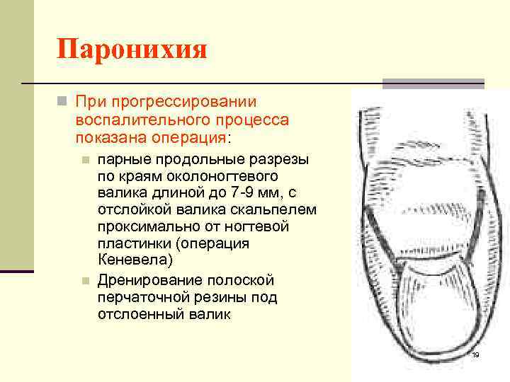 Паронихия n При прогрессировании воспалительного процесса показана операция: n n парные продольные разрезы по