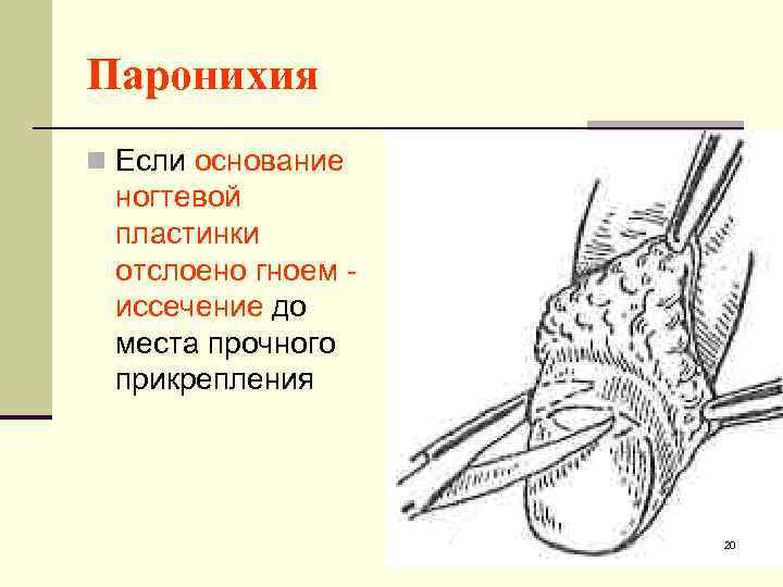 Паронихия n Если основание ногтевой пластинки отслоено гноем иссечение до места прочного прикрепления 20