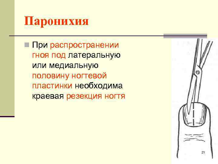 Паронихия n При распространении гноя под латеральную или медиальную половину ногтевой пластинки необходима краевая