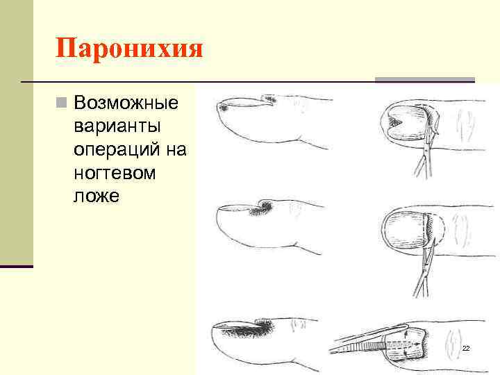 Паронихия n Возможные варианты операций на ногтевом ложе 22 