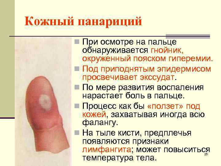 Кожный панариций n При осмотре на пальце обнаруживается гнойник, окруженный пояском гиперемии. n Под