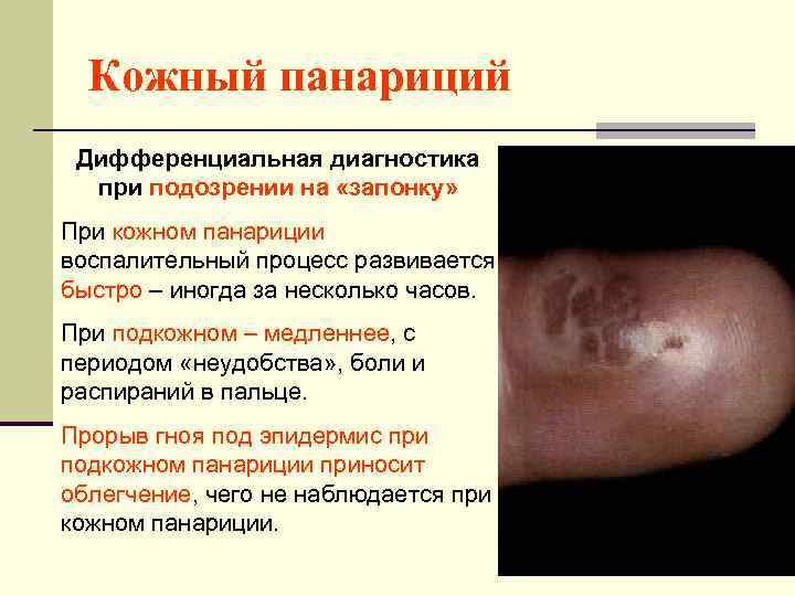 Кожный панариций Дифференциальная диагностика при подозрении на «запонку» При кожном панариции воспалительный процесс развивается