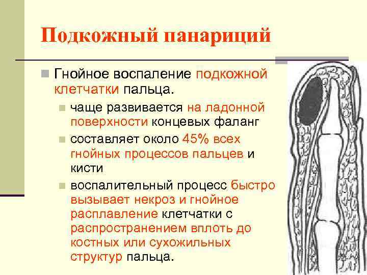 Подкожный панариций n Гнойное воспаление подкожной клетчатки пальца. чаще развивается на ладонной поверхности концевых
