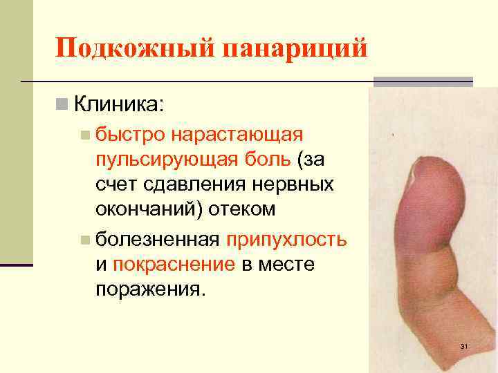 Подкожный панариций n Клиника: n быстро нарастающая пульсирующая боль (за счет сдавления нервных окончаний)
