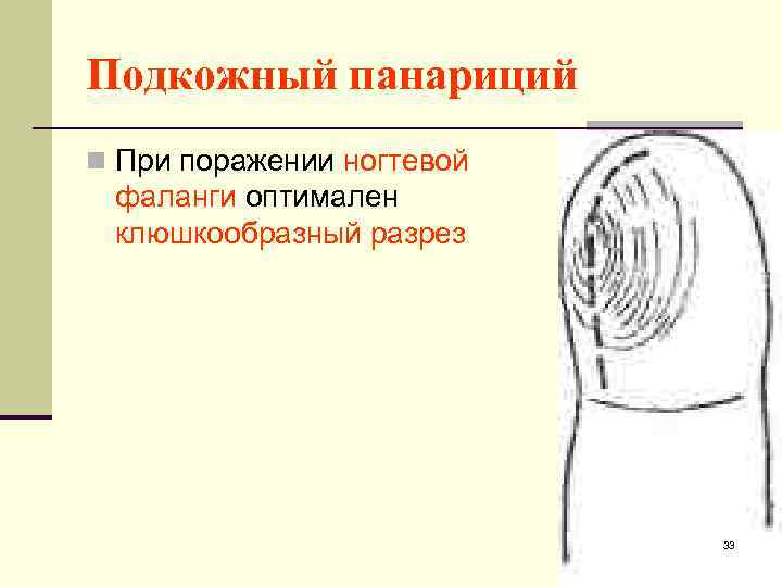 Подкожный панариций n При поражении ногтевой фаланги оптимален клюшкообразный разрез 33 