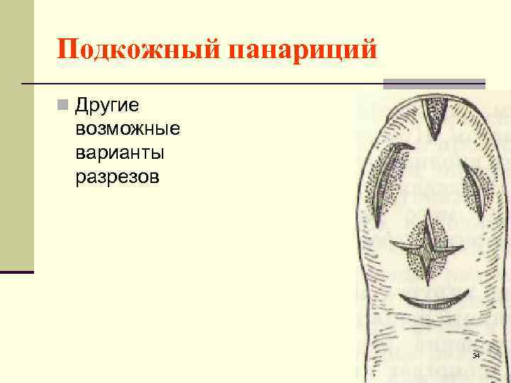 Подкожный панариций n Другие возможные варианты разрезов 34 