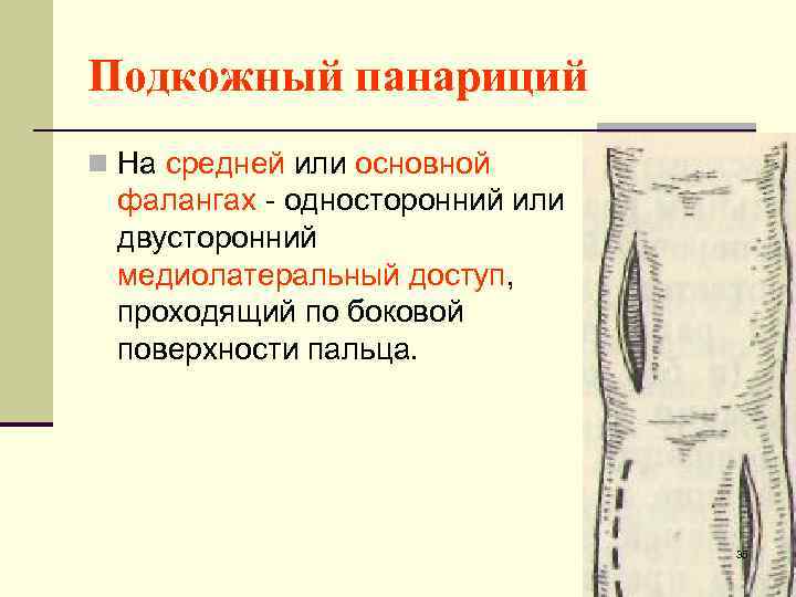 Подкожный панариций n На средней или основной фалангах - односторонний или двусторонний медиолатеральный доступ,