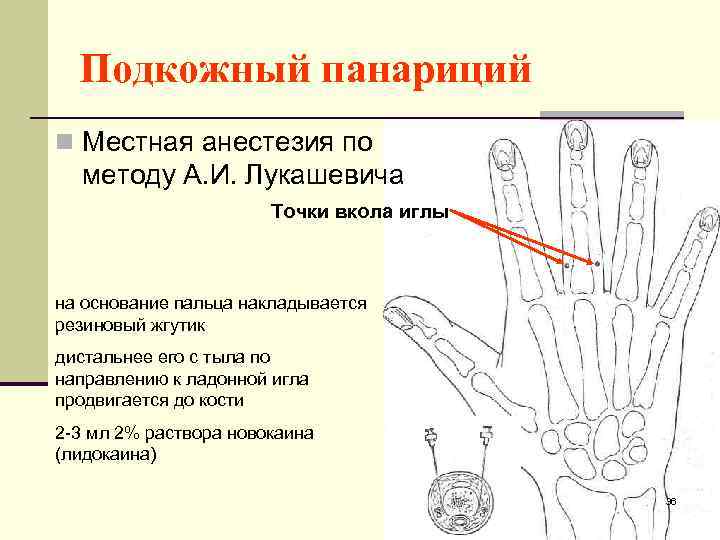 Подкожный панариций n Местная анестезия по методу А. И. Лукашевича Точки вкола иглы на