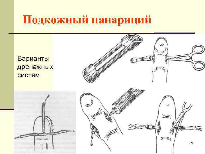Подкожный панариций Варианты дренажных систем 38 