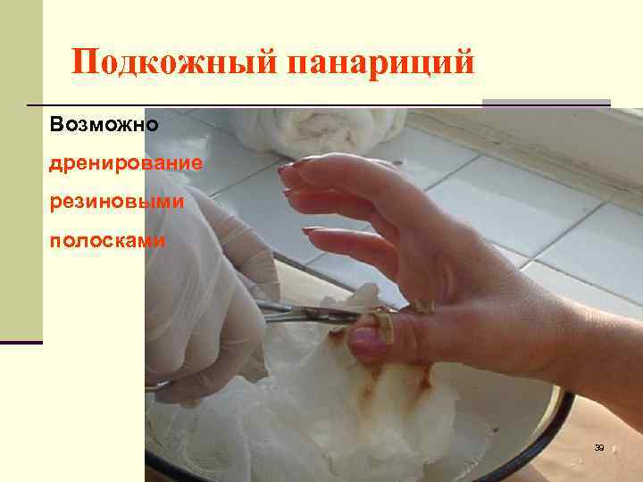 Подкожный панариций Возможно дренирование резиновыми полосками 39 