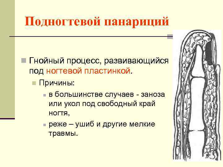 Подногтевой панариций n Гнойный процесс, развивающийся под ногтевой пластинкой. n Причины: n в большинстве