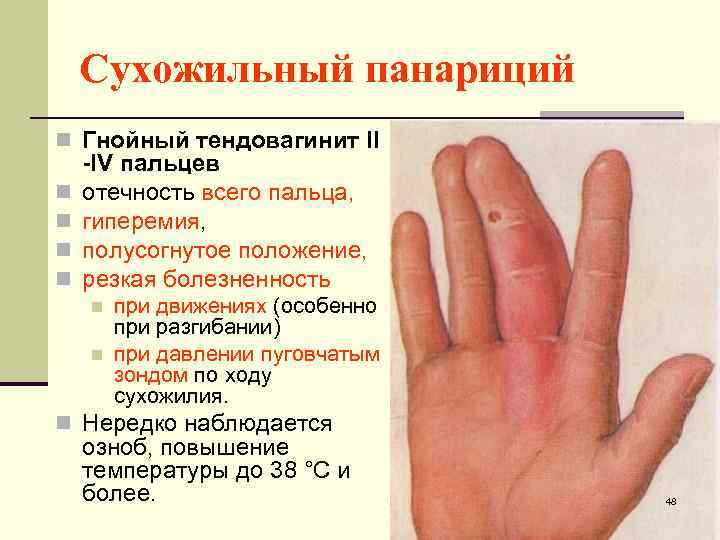 Сухожильный панариций n Гнойный тендовагинит II n n -IV пальцев отечность всего пальца, гиперемия,