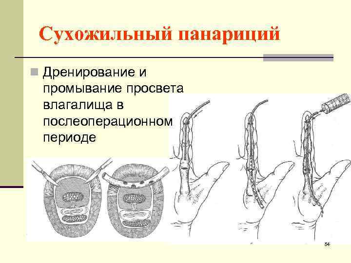 Сухожильный панариций n Дренирование и промывание просвета влагалища в послеоперационном периоде 54 