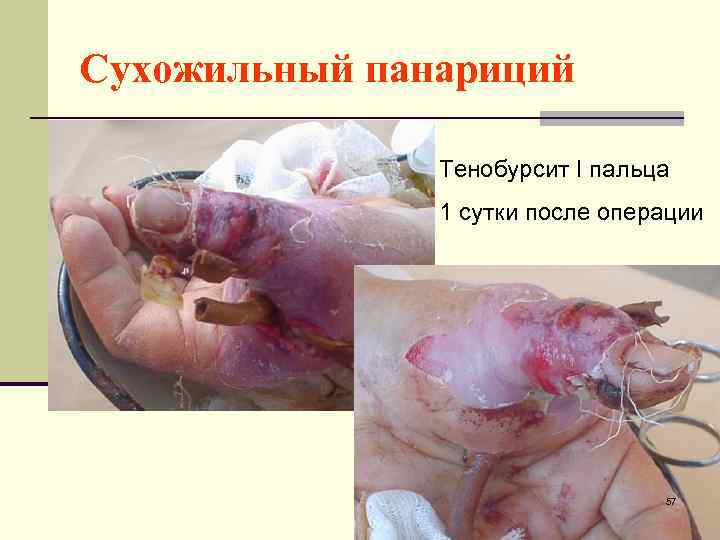 Сухожильный панариций Тенобурсит I пальца 1 сутки после операции 57 