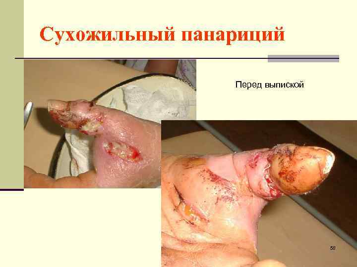 Сухожильный панариций Перед выпиской 58 