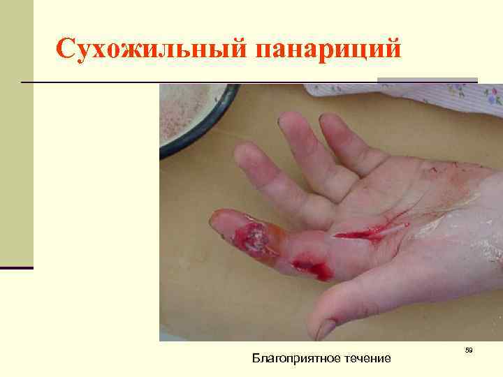 Сухожильный панариций Благоприятное течение 59 