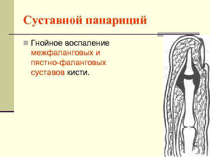 Суставной панариций n Гнойное воспаление межфаланговых и пястно-фаланговых суставов кисти. 60 